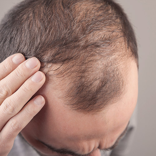 Alopecia: entendendo a queda de cabelo - Saúde em Pauta - Institucional
